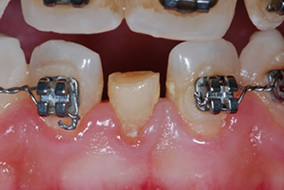 Implantes dentales Alboraya, Valencia