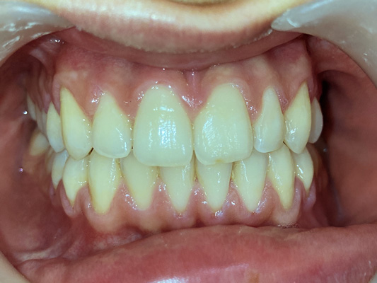 Invisalign full: el tratamiento efectivo que acaba con tu maloclusión dental